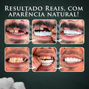 (Nature Smile) - Facetas Dentárias Removíveis Superior e Inferior